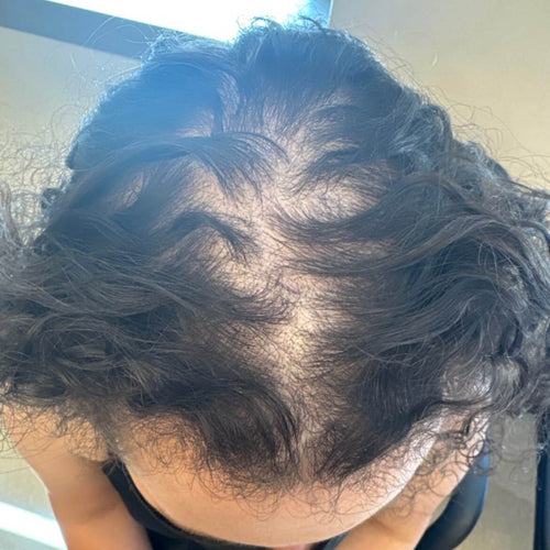 Alopecia Booking - Makeri Beauty
